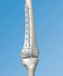 پلاک آناتومیکال دیستال فمور - طب دائم - TebDaem