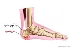 پد خار پاشنه بیتل