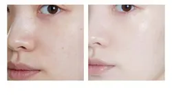 نخ بوتاکس جذبی پوست