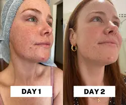 ماسک زغال وسالیسیلک اسید اوردینری