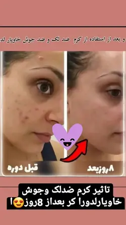 کرم ضدلک وجوش خاویار لدورا 50میای کد 41577