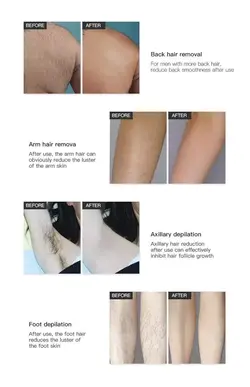 دستگاه لیزر موهای زائد دایود و حذف تاتو پیکوشور پیکوثانیه - روناهی کالا