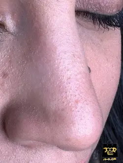 پک از بین برنده سرسیاه بینی برند  BEOTUA