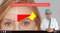 آموزش تزریق بوتاکس پیشانی، اخم و گوشه چشم ها