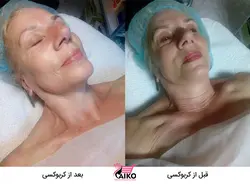 ژل کربوکسی تراپی ریب اسکین RIBESKIN
