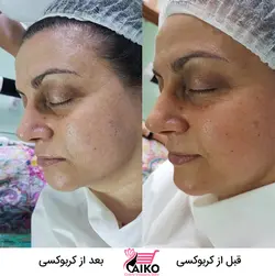 ژل کربوکسی تراپی ریب اسکین RIBESKIN