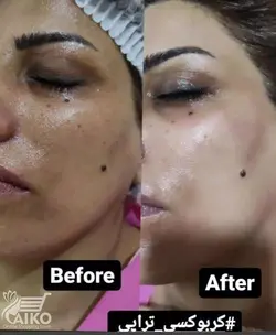 ژل کربوکسی تراپی آلفا بیسابولول دکتر درمر Dr Dermer