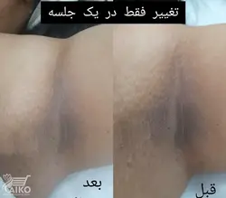 ژل کربوکسی تراپی ویتامین E دکتر درمر Dr Dermer