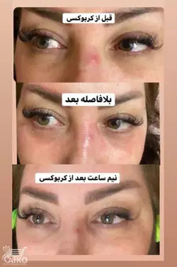 ژل کربوکسی تراپی ویتامین E دکتر درمر Dr Dermer