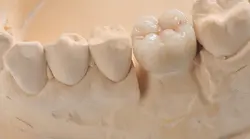 گچ دندانپزشکی