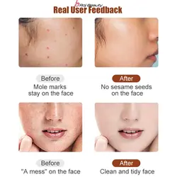 دستگاه لیزر پلاسما 9حالته شارژی پاک کننده زگیل خال ولکه وکوشت اضافی مدل 2023