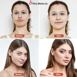 دستگاه لیزر پلاسما 9حالته شارژی پاک کننده زگیل خال ولکه وکوشت اضافی مدل 2023