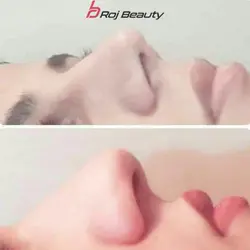 چسب لیفت بینی باریک اصل کره