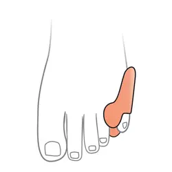 پد فاصله دهنده و ضد پینه با ساپورت انگشت کوچک اتسی OTESSY TF06