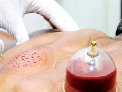 حجامت درمانی