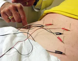 طب سوزنی(درمانی،لاغری،زیبایی)