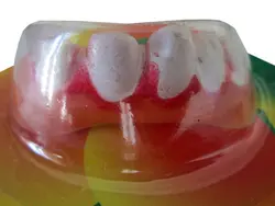 دندان مصنوعی یک طرف