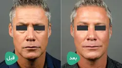 ژل رفع چین وچروک پوست نورامیس لیدوکائین، فیلر Neuramis Lidocaine