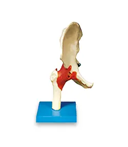 مولاژ مفصل لگن