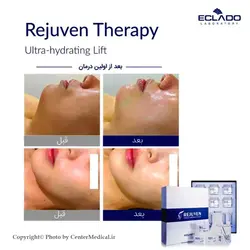 تراپی آبرسان و لیفتینگ ریجوون اکلادو