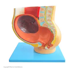 مولاژ حاملگی (جنین ۹ ماهه در رحم)