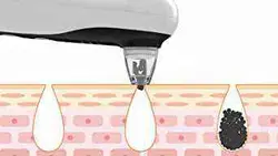 میکرودرم هات اند کلد Hot and Cold Microderm