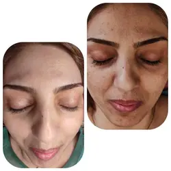 محلول اسید تراپی دکتر نوشا مدل AHA