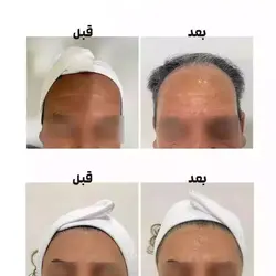 پک نخ کلاژن ساز و سرم جذبی برند ADAD