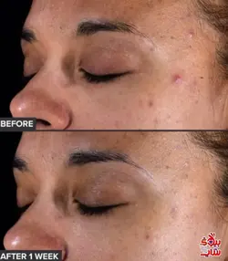 تونر پوست چرب و جوشدار  پائولا چویس PAULA'S LE CHOICE XFOL IAT SKIN PERFECTING 2% BHA Liquid Exfoliant SALICYLIC ACID All Skin Types UNCLOGS & SHRINKS ENLARGED PORES SMOOTHS &EVENS SKIN TONE LIGHTWEIGHT LIQUID ABSORBS QUICKLY  118 ml