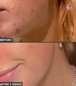 تونر پوست چرب و جوشدار  پائولا چویس PAULA'S LE CHOICE XFOL IAT SKIN PERFECTING 2% BHA Liquid Exfoliant SALICYLIC ACID All Skin Types UNCLOGS & SHRINKS ENLARGED PORES SMOOTHS &EVENS SKIN TONE LIGHTWEIGHT LIQUID ABSORBS QUICKLY  118 ml