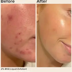 تونر پوست چرب و جوشدار  پائولا چویس PAULA'S LE CHOICE XFOL IAT SKIN PERFECTING 2% BHA Liquid Exfoliant SALICYLIC ACID All Skin Types UNCLOGS & SHRINKS ENLARGED PORES SMOOTHS &EVENS SKIN TONE LIGHTWEIGHT LIQUID ABSORBS QUICKLY  118 ml