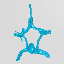 آنوریسم حلقه ویلیس (circle of willis aneurysm)