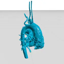 مولاژ آنوریسم آئورت صعودی (ascending aort aneurysm)