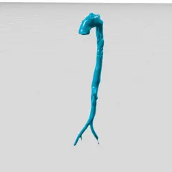 مولاژ دایسکشن آئورت (aortic dissection)
