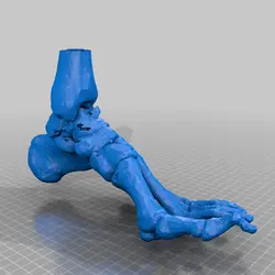 مولاژ شکستگی استخوان تالوس (talus fracture)