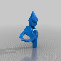 مولاژ شکستگی لگن (pelvic fracture)