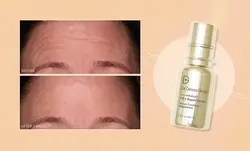 سرم ضدچروک و فیلر دکتر دنیس گراس