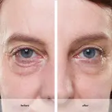 کرم بوتاکس دور چشم آون امریکا اورجینال