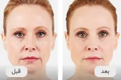 دستگاه دکترپن میکرونیدلینگ مدل A6 دکتر پن derma pen A6 Dr.pen microneedling - فروشگاه ققنوس