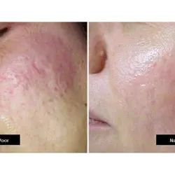 دستگاه دکترپن میکرونیدلینگ مدل A6 دکتر پن derma pen A6 Dr.pen microneedling - فروشگاه ققنوس