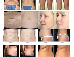 دستگاه لاغری کرایو لیپو لیزر360 درجه - هدیه بیوتی