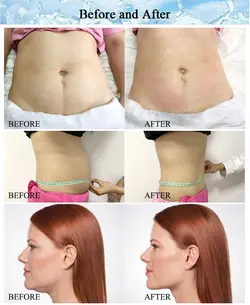 دستگاه لاغری کرایو لیپو لیزر360 درجه - هدیه بیوتی