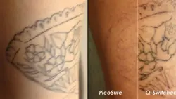 دستگاه لیزر پیکوشور حذف تاتو با کربن تراپی و پوست گرید A با یک سال گارنتی