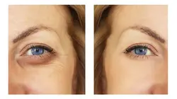 کوکتل مزوتراپی زیر چشمی مزولایک