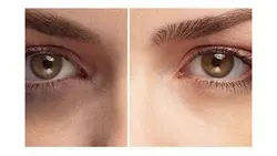 کوکتل مزوتراپی زیر چشمی مزولایک