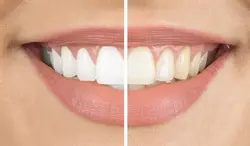 پودر جرمگیر و سفید کننده دندان اونیس