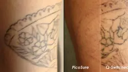 دستگاه لیزر پیکوشور پاکسازی تاتو و کربن تراپی پوست گرید A تضمینی یک سال گارانتی