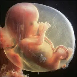 پاورپوینت پره اکلامپسی ویژگی های بالینی و تشخیص Preeclampsia