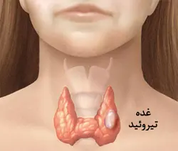 پاورپوینت اختلالات ناشی از کمبود ید