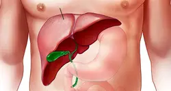 پاورپوینت کله سیستیت (التهاب كيسه ي صفرا )